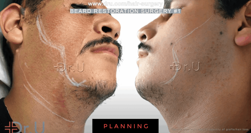 Dr.U marks off the regions and shape of the patient's overall beard reconstruction results