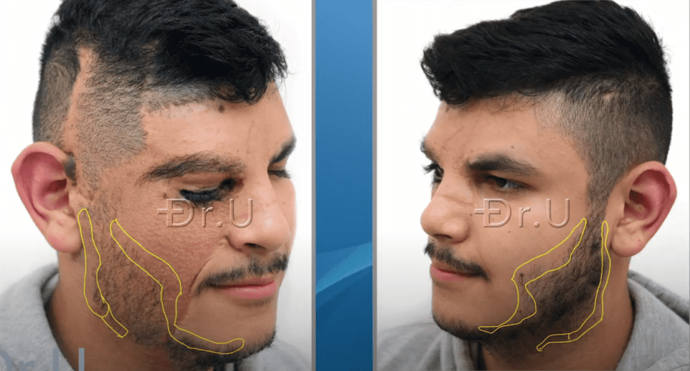 Yellow markings illustrate Dr.U's planning for the new beard contours on the right side which would mirror the left side of the patient's face
