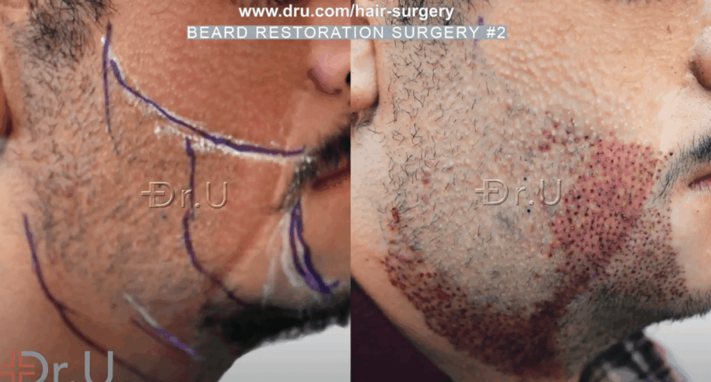Dr.U outlines specific regions for inserting leg and nape donor grafts to complete the patient's final beard reconstruction results *