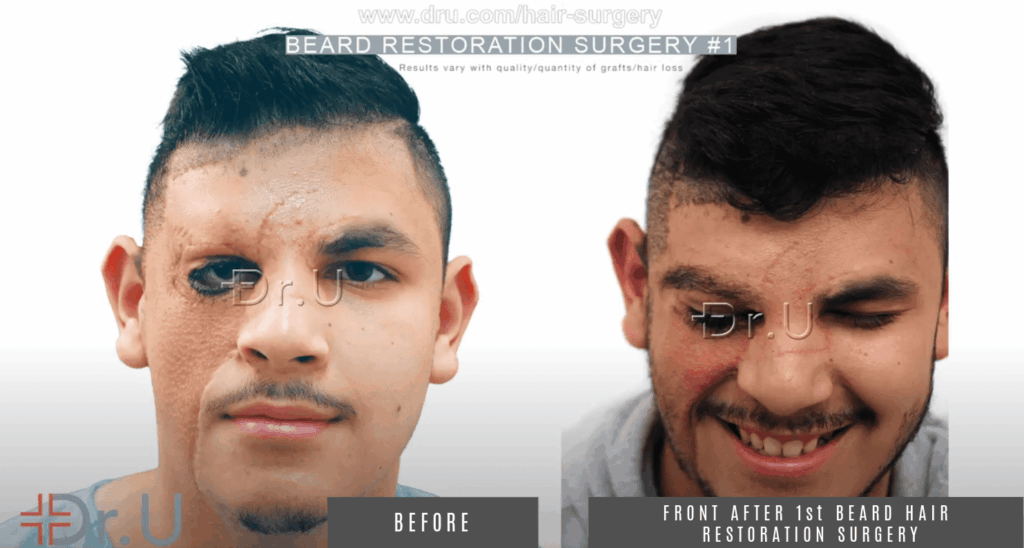 Patient is please with his complete beard results after his first procedure with Dr.u 