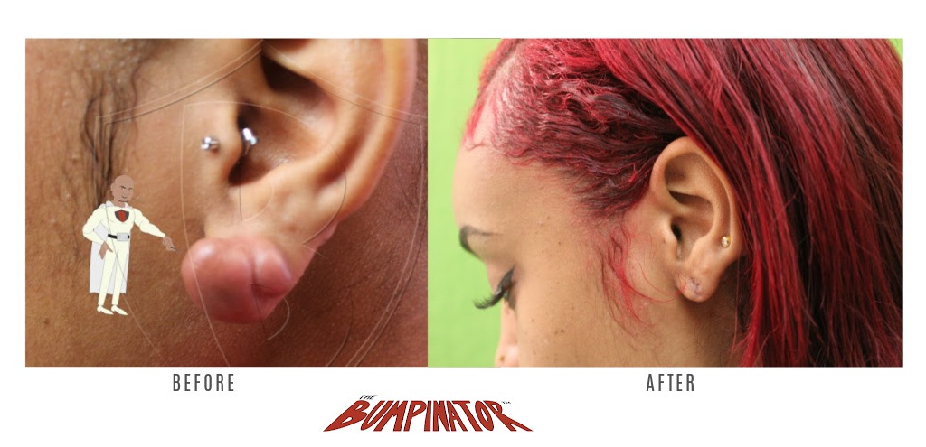 Before and after images depicting keloid removal on the left ear