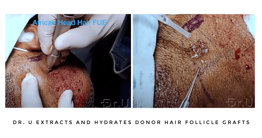 Dr.U performs highly specialized extractions required for the skin thickness of black patients. He and his team also work to keep the donor follicles hydrated. Air exposure is considered the leading cause of hair transplant graft failure 