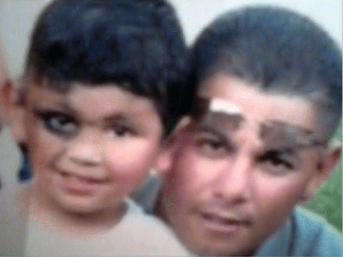 Patient is seen with his father after undergoing a skin graft procedure which replaced the congenital nevus. 