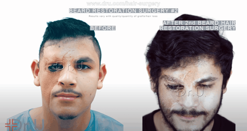 Patient's final beard reconstruction results helps camouflage the seams of his skin graft inserted on the right side of his face*