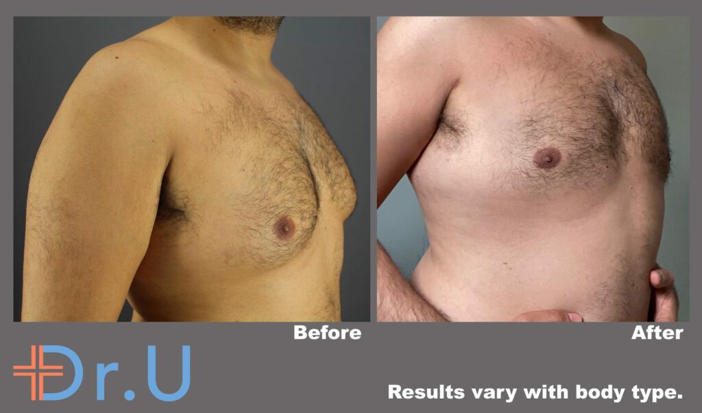 Three quarter's view from the right side showing a significant reduction of this patient's male breasts following his procedure *