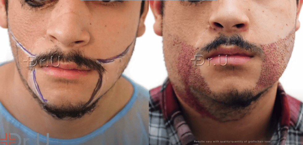 Markings on the left photo depict the planning for the refined beard contours which will have sharper transition points that adjoin the patient's mustache