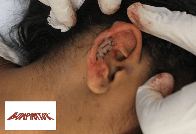 Dr.U affixes a keloid-harnessed flap to close the remaining wound