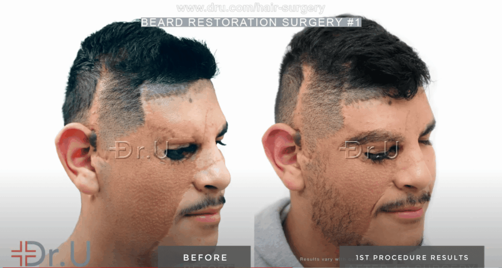 Following his first reconstruction procedure with Dr.U, patient now has normal-looking beard growth on the right side of his face 