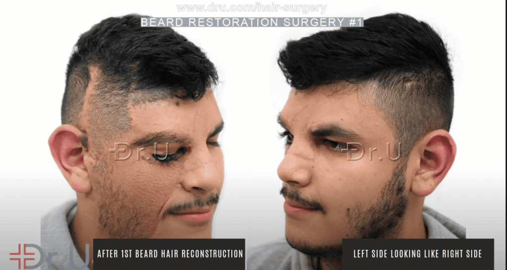 Patient's results following first procedure to recreate the basic beard shape seen on the left side of his face 