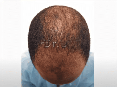  Top view of patient's head at the Norwood 5 hair loss level