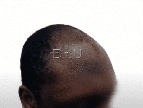 Right view of black male patient's receded temples