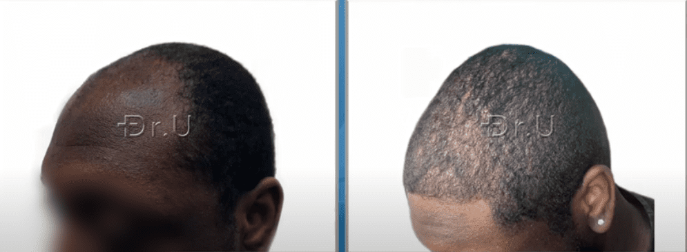 Left side view of black male patient's new hairline and temples. He now sports an age-appropriate appearance thanks to his hair transplant procedure performed by Dr. U