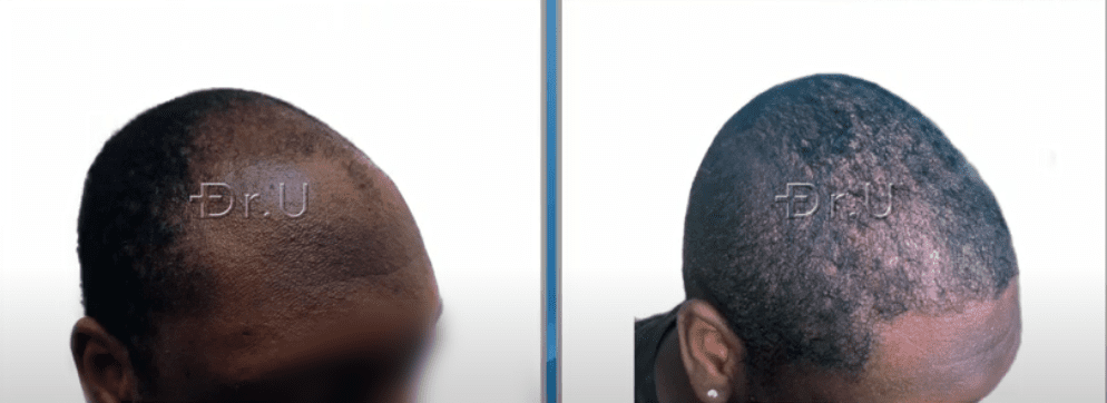 Before and after photos depict fuller coverage and well-designed temples, shown on the right side of this patient's face