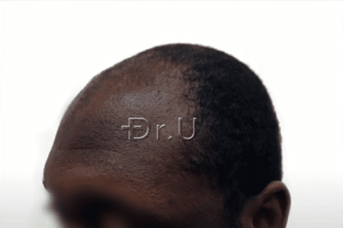 Left view of black male patient's receded temples
