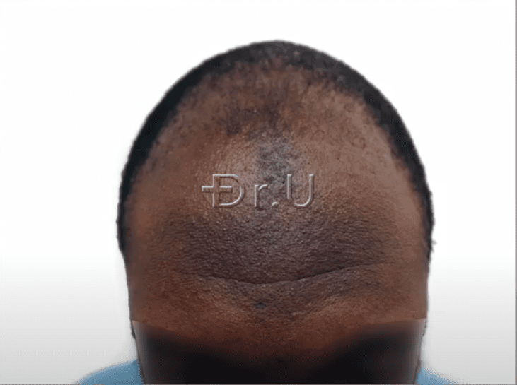 Patient's hairline had receded considerably causing him to appear much older than his actual age. 