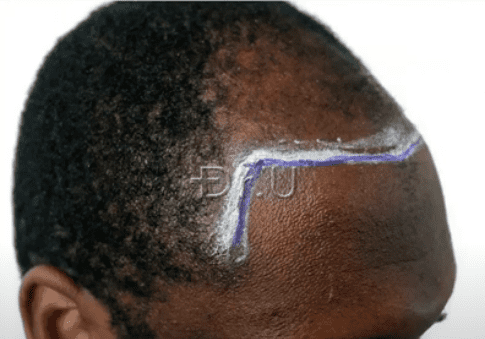 Dr.U designates new temple contours shown on the right side of the patient's face 