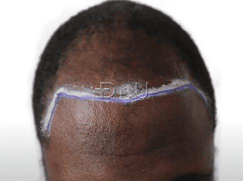 Dr.U planned a new hairline and temples to frame the patient's face and help him achieve a much younger looking appearance. 