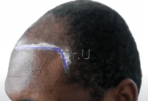 Left side view of Dr. Umar's planning for patient's hairline and temples