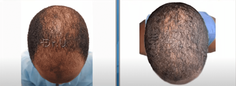 Top of black male patient's head now has more coverage through the use of just 3000 grafts