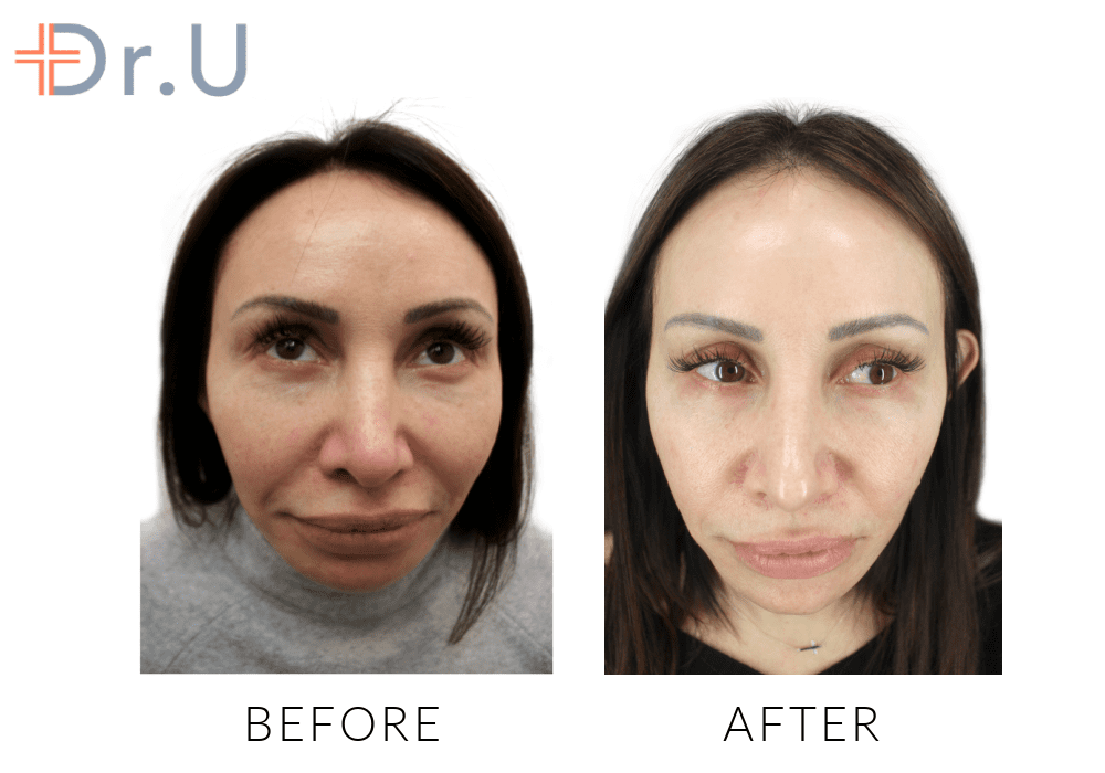 This woman noticed a beautiful skin glow and overall rejuvenation, made possible by Morpheus 8.