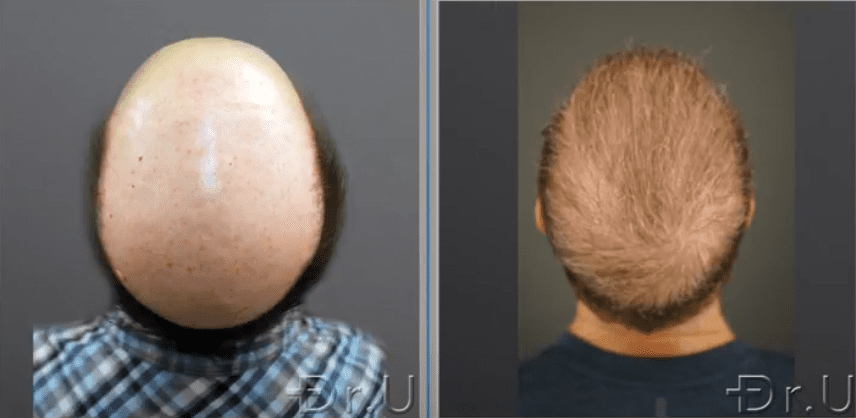 Patient's crown now has a natural-looking whorl Patient's crown now has a natural-looking whorl