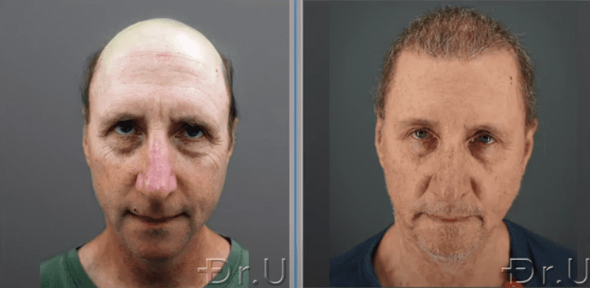 Before and after photos show the front view of Dr. U's patient at 8 months following his Dr.UGraft Zeus procedure.* Before and after photos show the front view of Dr. U's patient at 8 months following his Dr.UGraft Zeus procedure.*