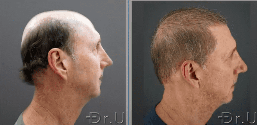 A side view of the patient's outcome shows an incredible improvement in his coverage after Dr UGraft Zeus severe baldness hair transplant A side view of the patient's outcome shows an incredible improvement in his coverage after Dr UGraft Zeus severe baldness hair transplant