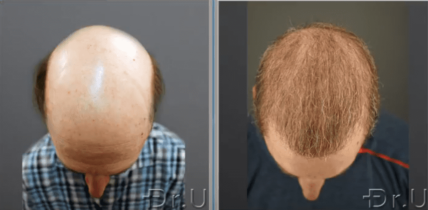 The top of this patient's head is no longer bald thanks to the prolific growth of his donor grafts The top of this patient's head is no longer bald thanks to the prolific growth of his donor grafts