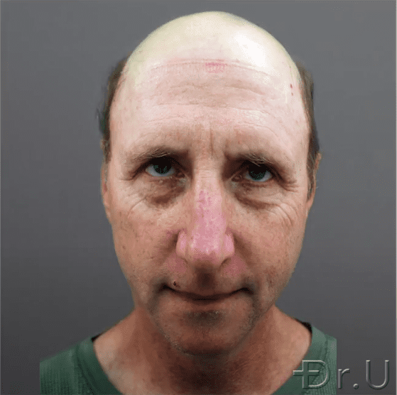 Front view of a severely bald patient who wishes to change his appearance through hair transplant surgery. Front view of a severely bald patient who wishes to change his appearance through hair transplant surgery.