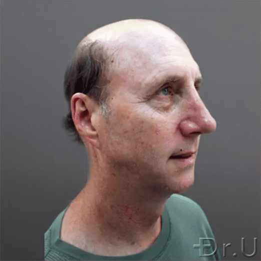 Side view of Dr.U's patient whose hair loss stage is worse than Norwood 7 Side view of Dr.U's patient whose hair loss stage is worse than Norwood 7