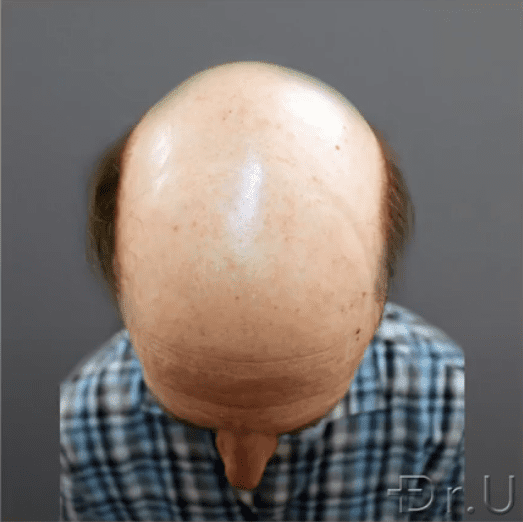 The top of the patient's head shows absolutely no hair growth The top of the patient's head shows absolutely no hair growth