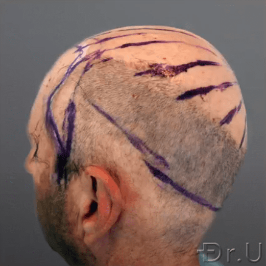 Dr.U marks off the directions and patterning of hair growth for this patient's final outcome* Dr.U marks off the directions and patterning of hair growth for this patient's final outcome*