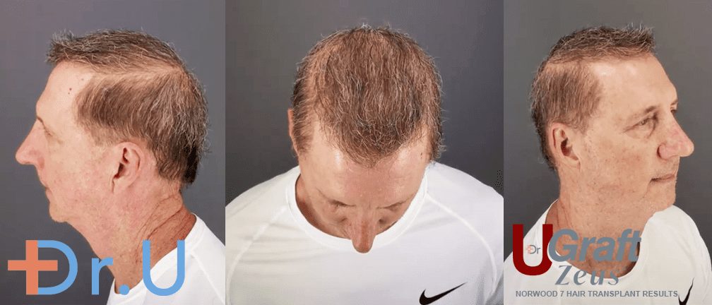 Severe Baldness Hair Restoration Results by Dr. U - Norwood Level 7*
