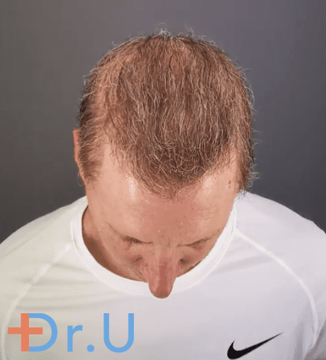 Norwood 8 Hair Restoration Dr. U