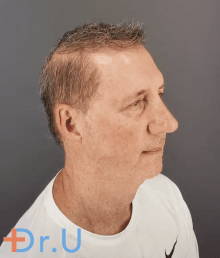 Happy Norwood 8 Hair restoration