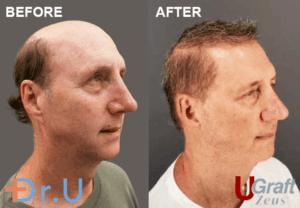 Dr.UGraft Zeus Patient Is No Longer Severely Bald