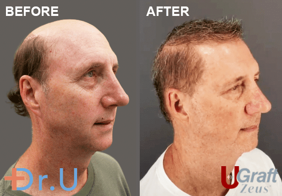 Complete Baldness Restoration Dr U