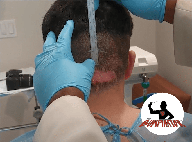 Measuring the AKN tissue, relative to scalp landmarks such as the occipital notch is an important step Measuring the AKN tissue, relative to scalp landmarks such as the occipital notch is an important step