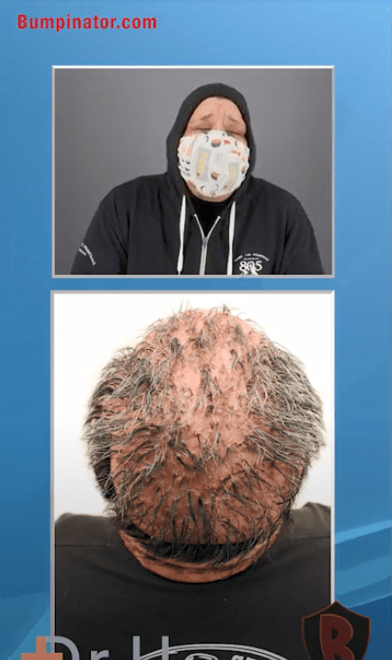 Back of Head - Before Dr.Bumpinator AKN Procedure