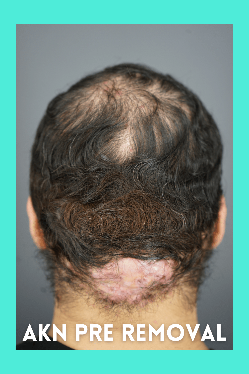 AKN Patient Pre Removal Picture Acne Keloidalis Nuchae - Dr. Bumpinator