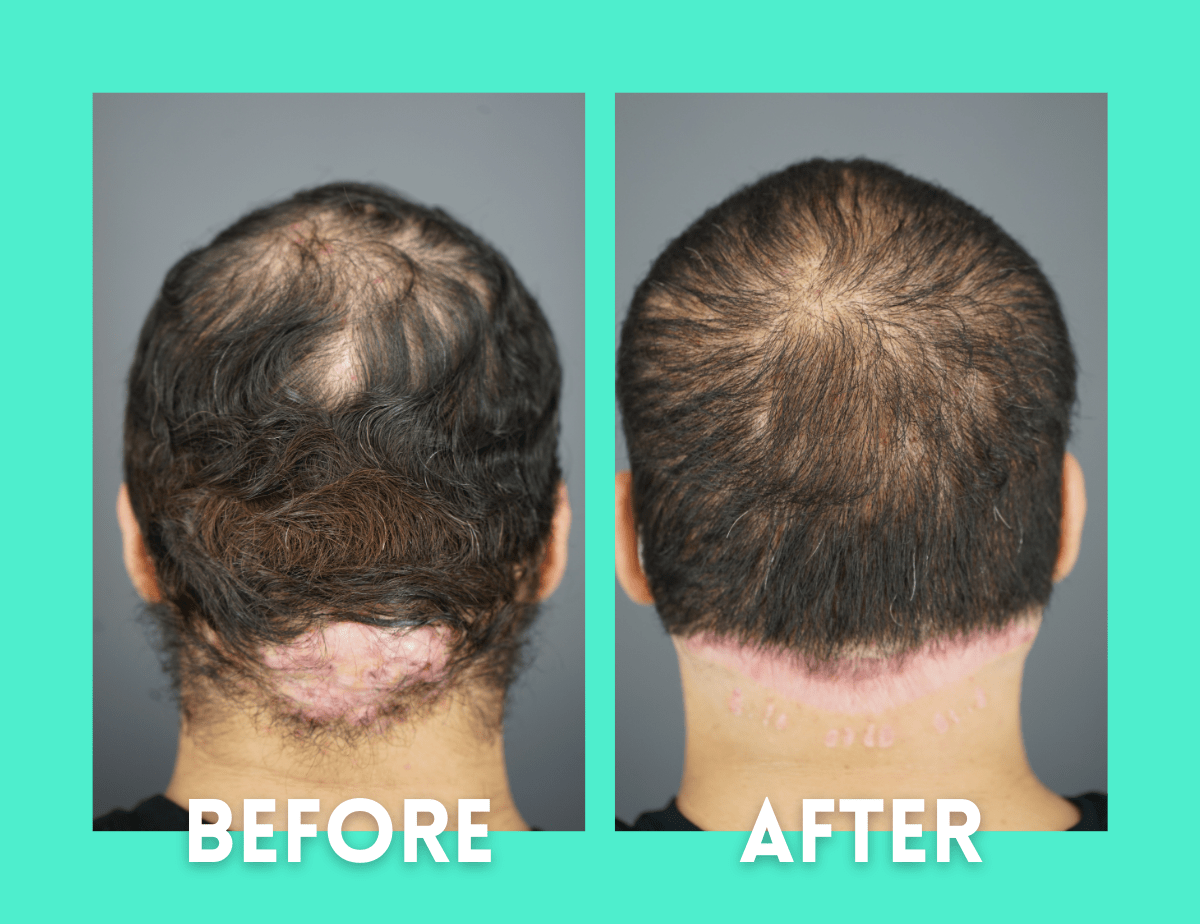 AKN Removal Patient Before and After Surgery Results Bumpinator Dr. U