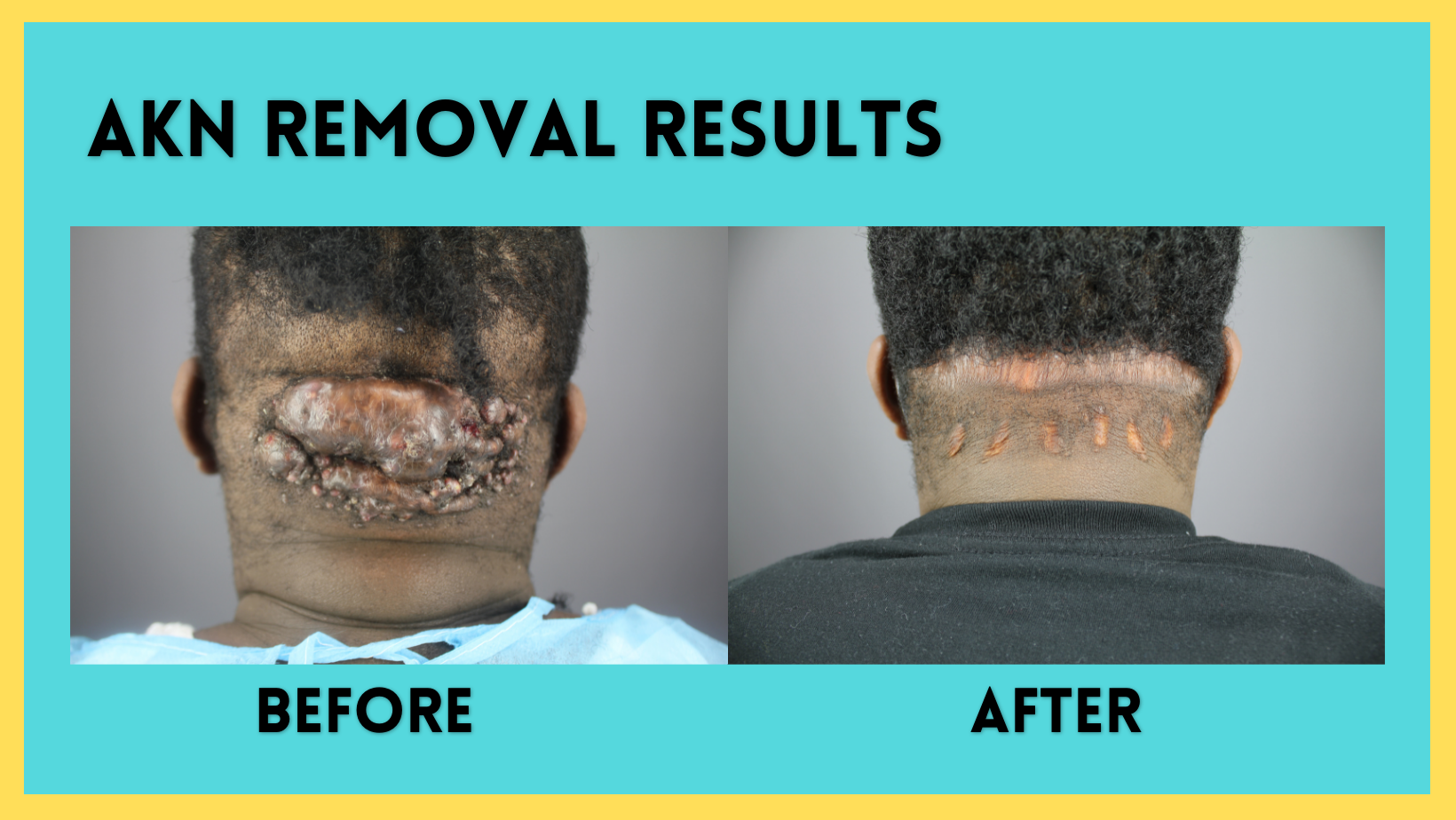 AKN Removal Results: Large Bump Removal Acne Keloidalis Nuchae Before & After Dr. U Bumpinator