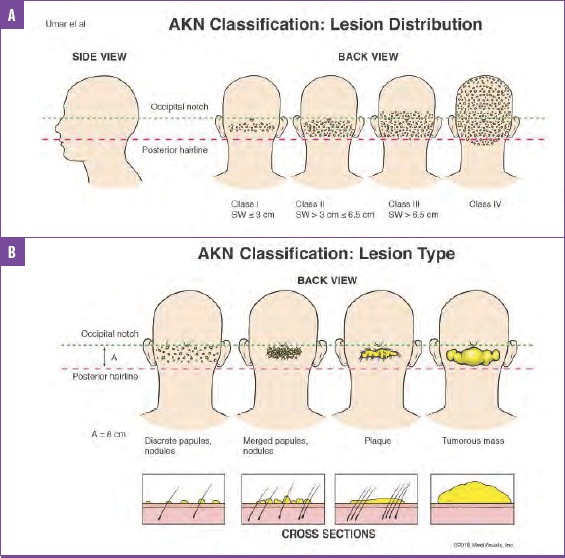 AKN Classification, Acne Keloidalis Nuchae Classification. Significant AKN findings researched and published by Dr. Sanusi Umar AKA Dr. U, The Bumpinator.