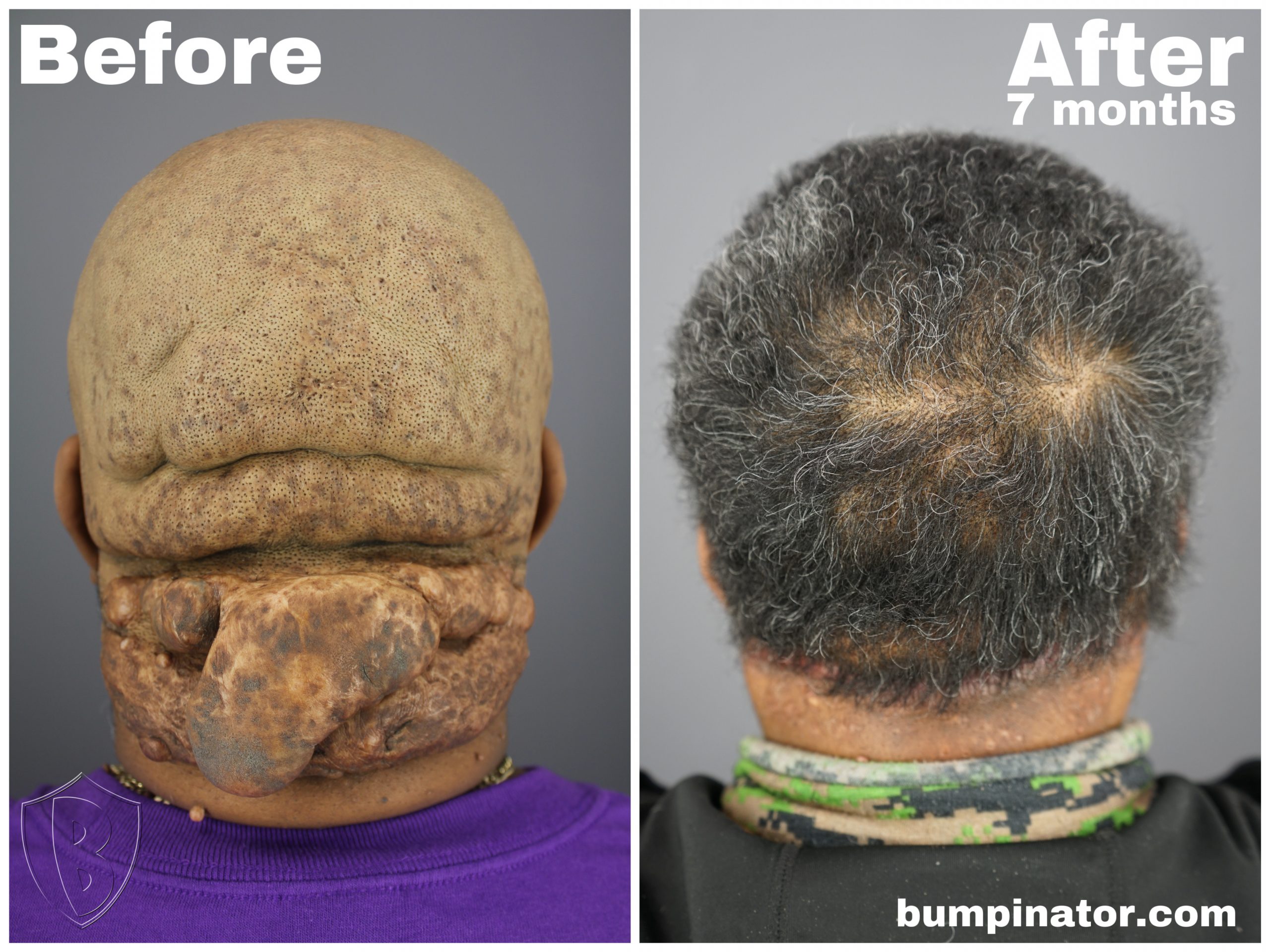 AKN Removal Before and After Picture - Acne Keloidalis Nuchae 7-Months Post Surgery Results. AKN Removal Before and After Picture - Acne Keloidalis Nuchae 7-Months Post Surgery Results.