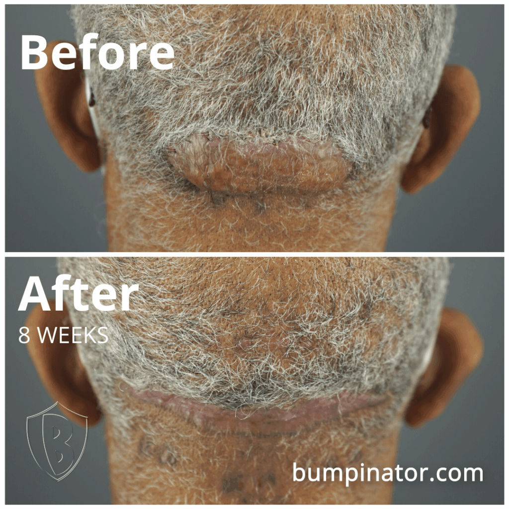 AKN can happen at any point during adulthood. Large AKN Bump Removal - Before & After AKN Surgery Results.