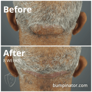 AKN can happen at any point during adulthood. Large AKN Bump Removal - Before & After AKN Surgery Results.