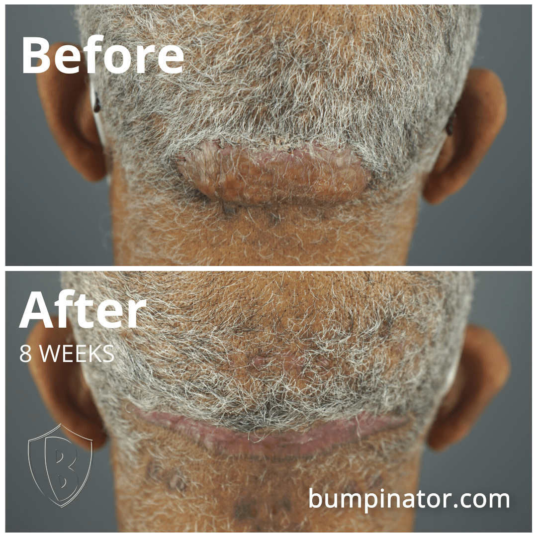 AKN can happen at any point during adulthood. Large AKN Bump Removal - Before &amp; After AKN Surgery Results.