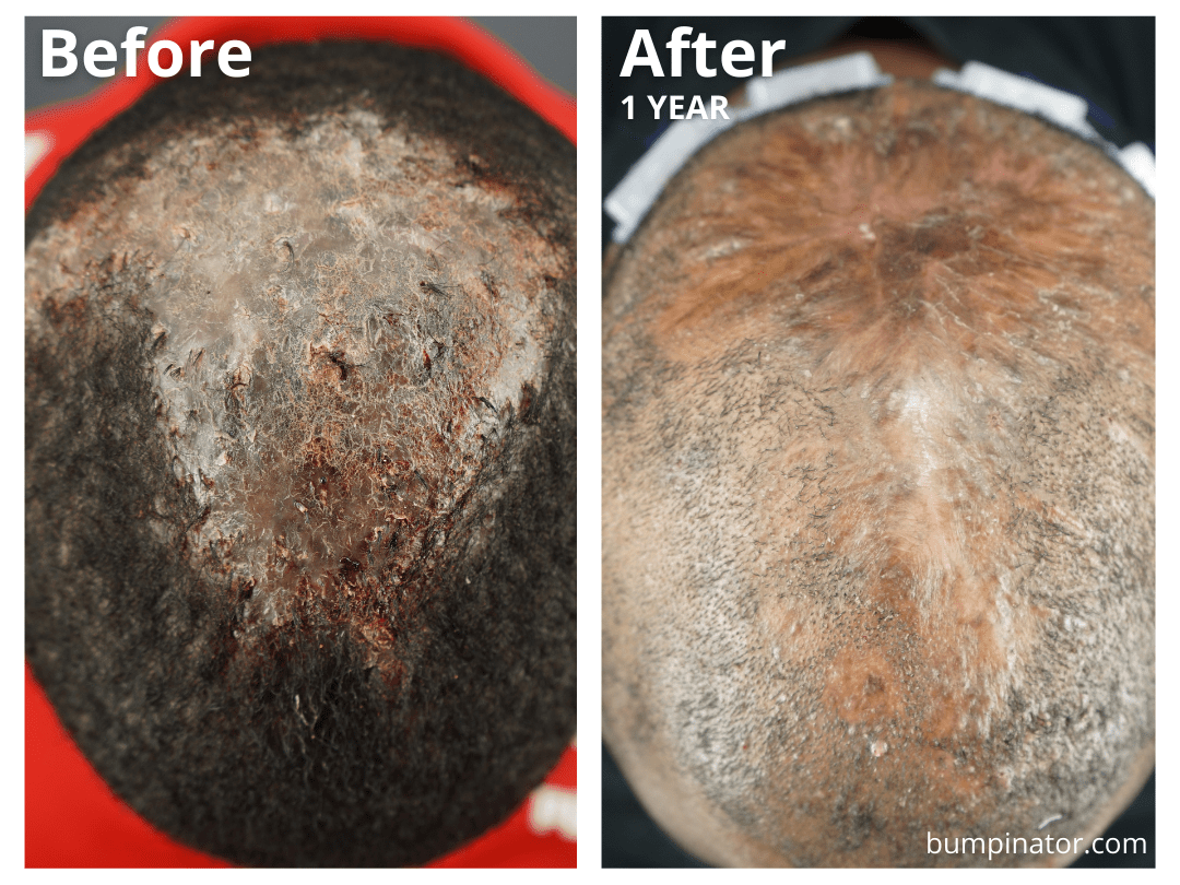 FD - Folliculitis Decalvans Surgical Removal Before and After Patient Results, 1-Year Post Surgery - Dr. U AKA The Bumpinator, Dr. U Skin & Hair Clinic.