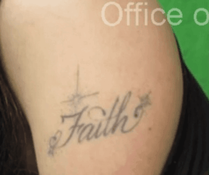 Black Ink Los Angeles Laser Tattoo Removal - Before Laser Tattoo Removal*