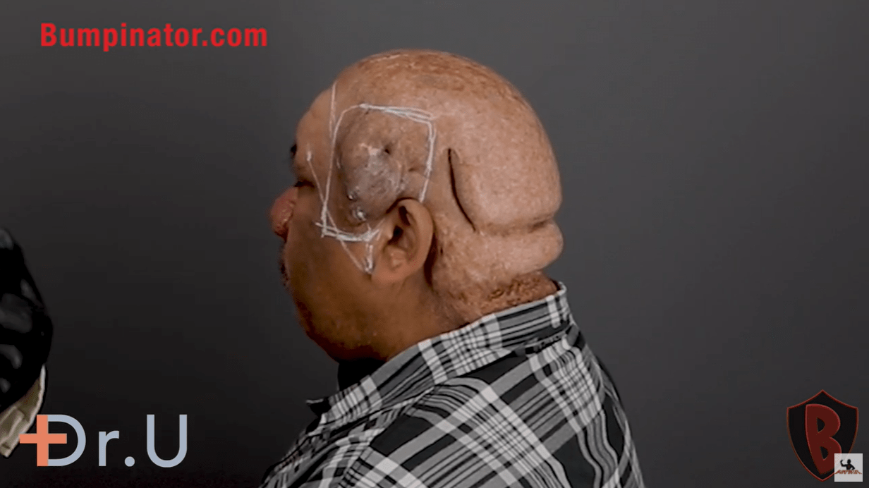 Removal of Large AKN Side Lesion - Robert Peeters by Dr. Sanusi Umar AKA The Bumpinator.